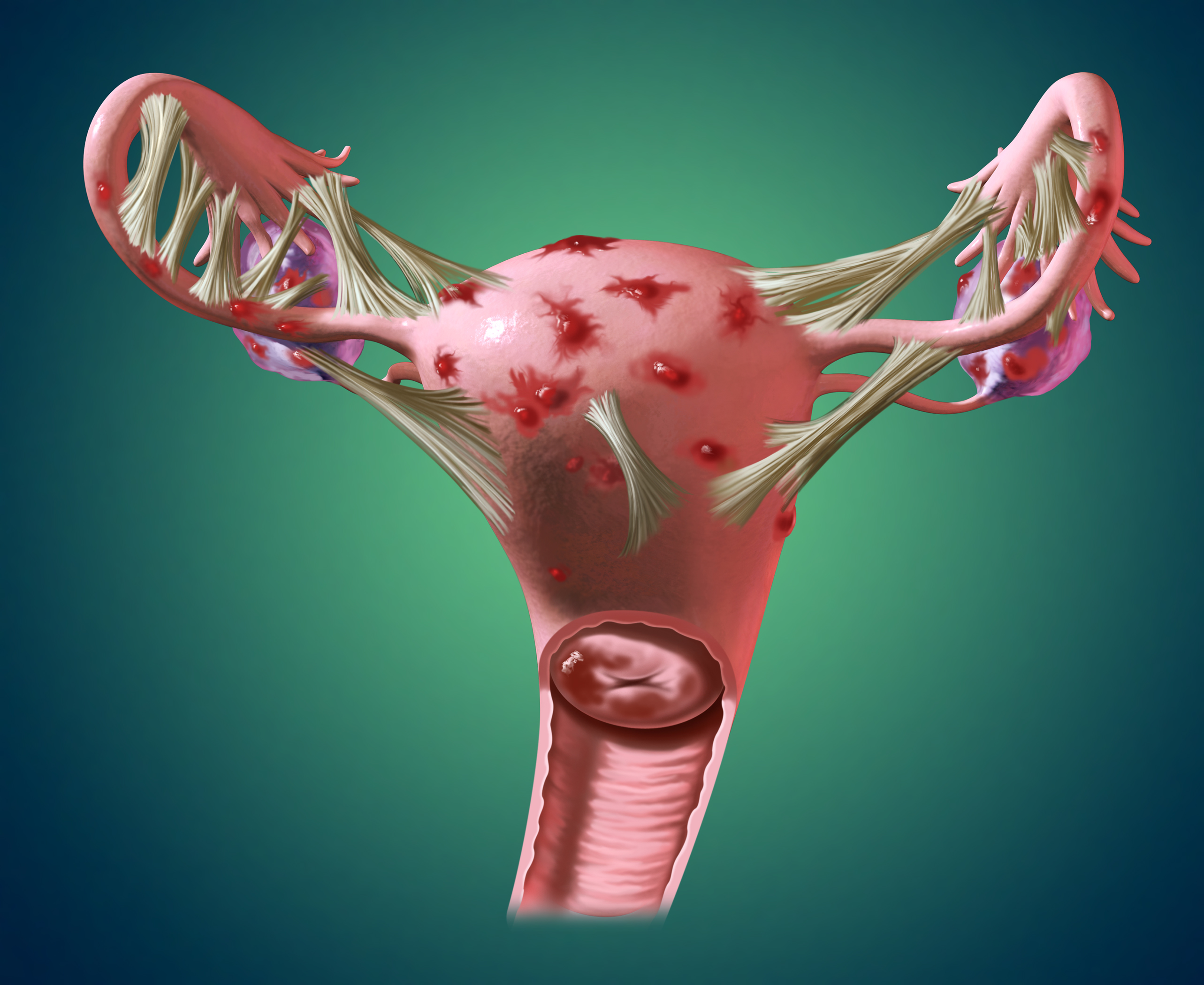 Resultado de imagen de endometriosis 3d