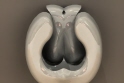 hemorrhoid removal facilitys