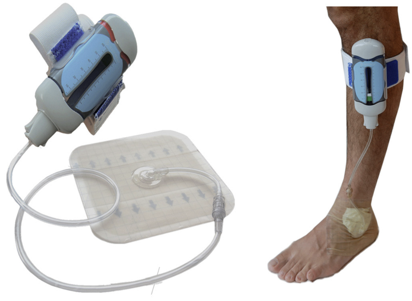 Spiracur SNaP Wound Care System by Brendan Donohoe at Coroflot.com