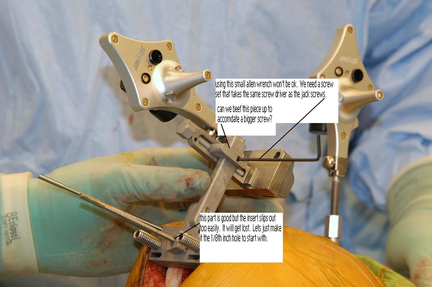 Femoral Block for Knee replacement surgery by Isaiah Coberly at