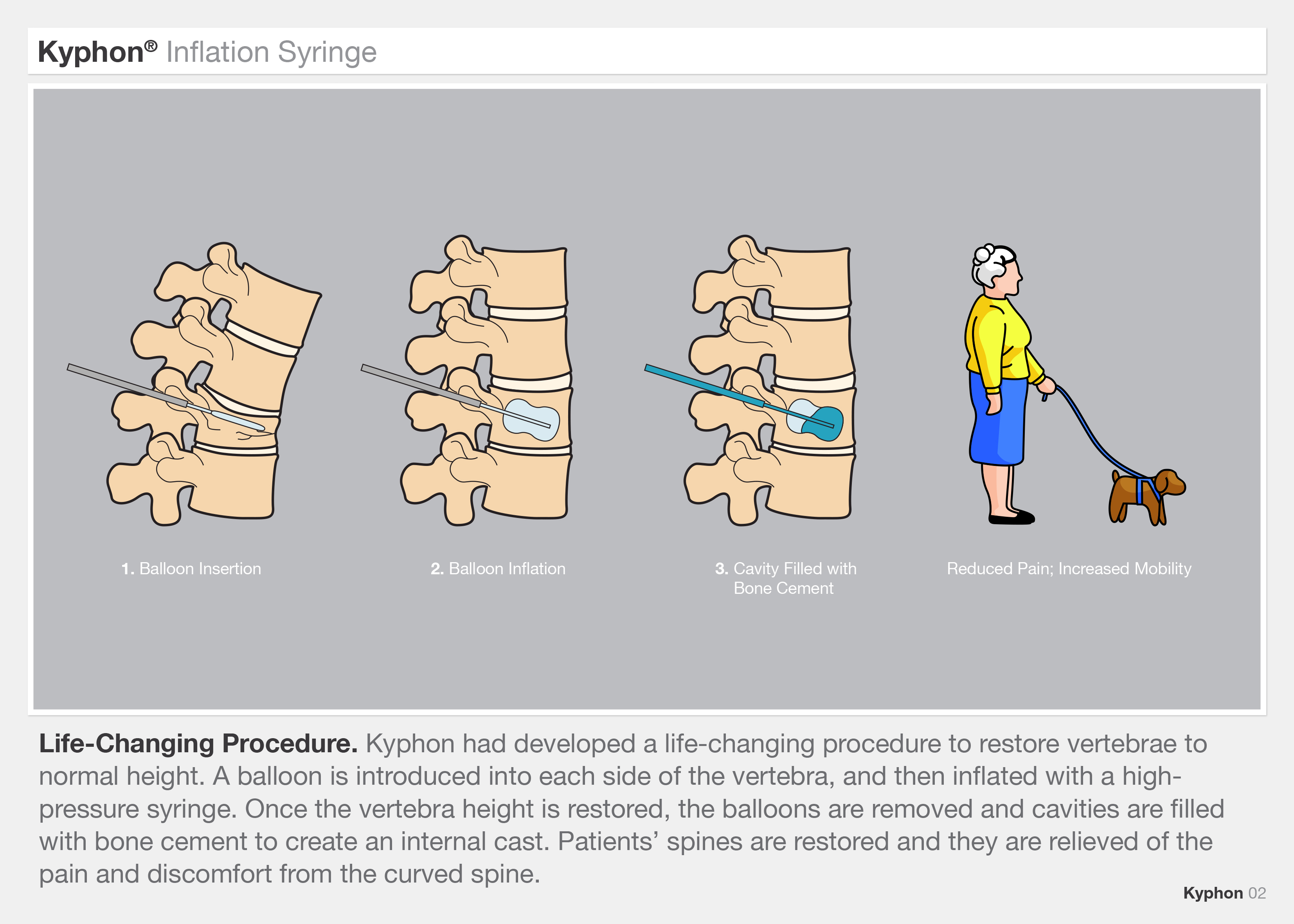 Medtronic Kyphon Inflation Syringe by Robert Hubler at