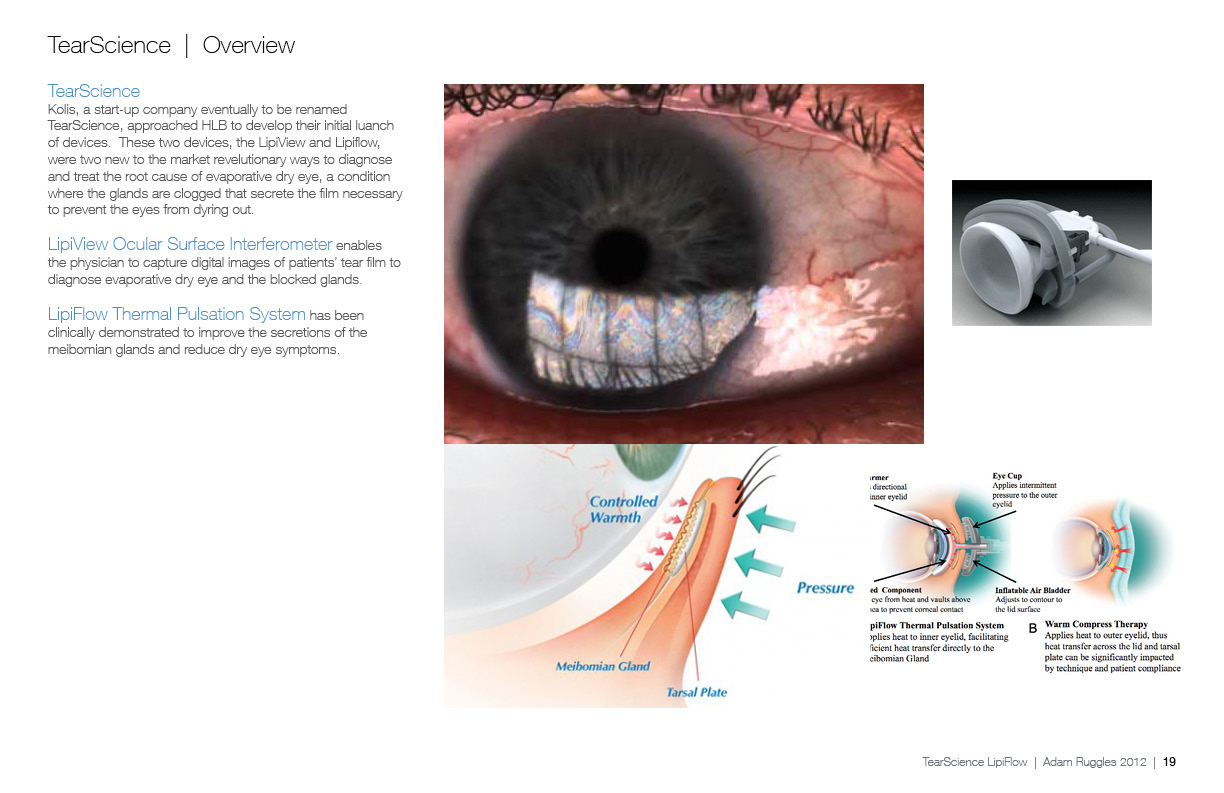 Diagnosing and treating evaporative dry eye by Adam Ruggles at